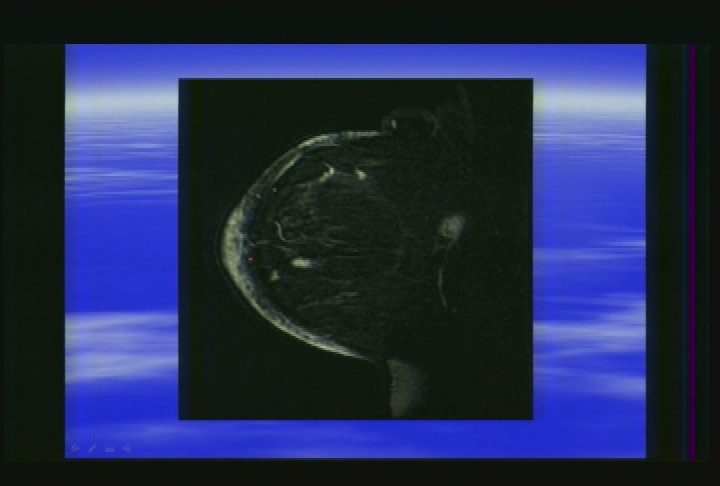 Thumbnail image for Berkshire Health Program, October, 2007.  'Breast Cancer Detection, Dr. Lisa Loring.'